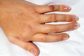 Deforme olmuş parmaklarda ağrı