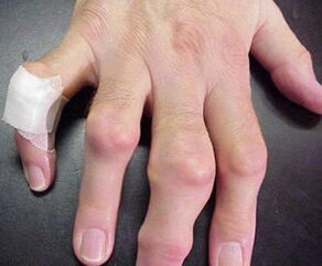 Eklem deformiteleri olan parmaklar ağrıya neden olur