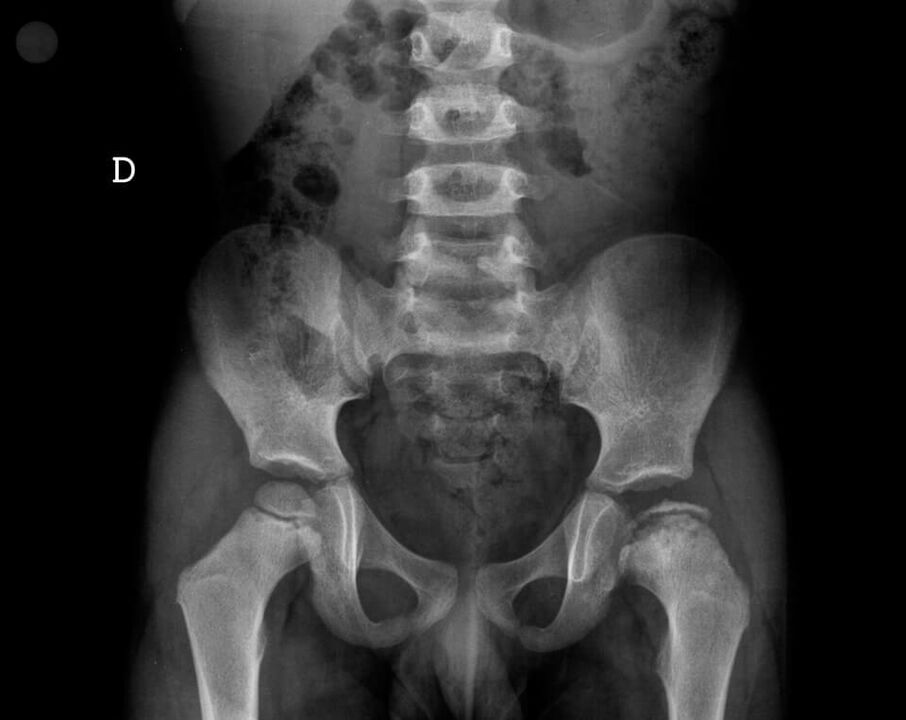 Legg-Calvé-Perthes hastalığı - femur başındaki kıkırdak dokusunun nekrozu