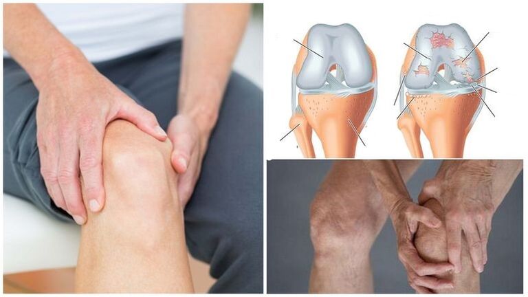 Diz ekleminin osteoartriti için diz ağrısı belirtisi