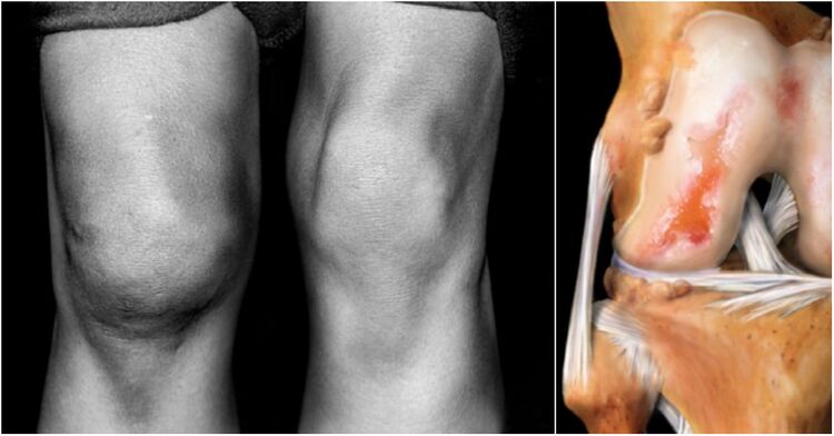 Diz ekleminin osteoartriti ve ağrının eklemi
