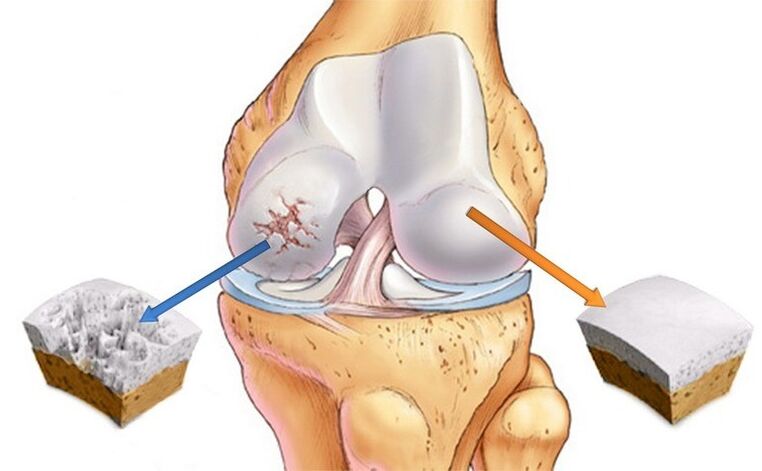 normal kıkırdak ve osteoartrit