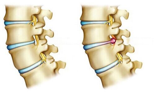 sağlıklı intervertebral disk ve fıtıklaşmış disk