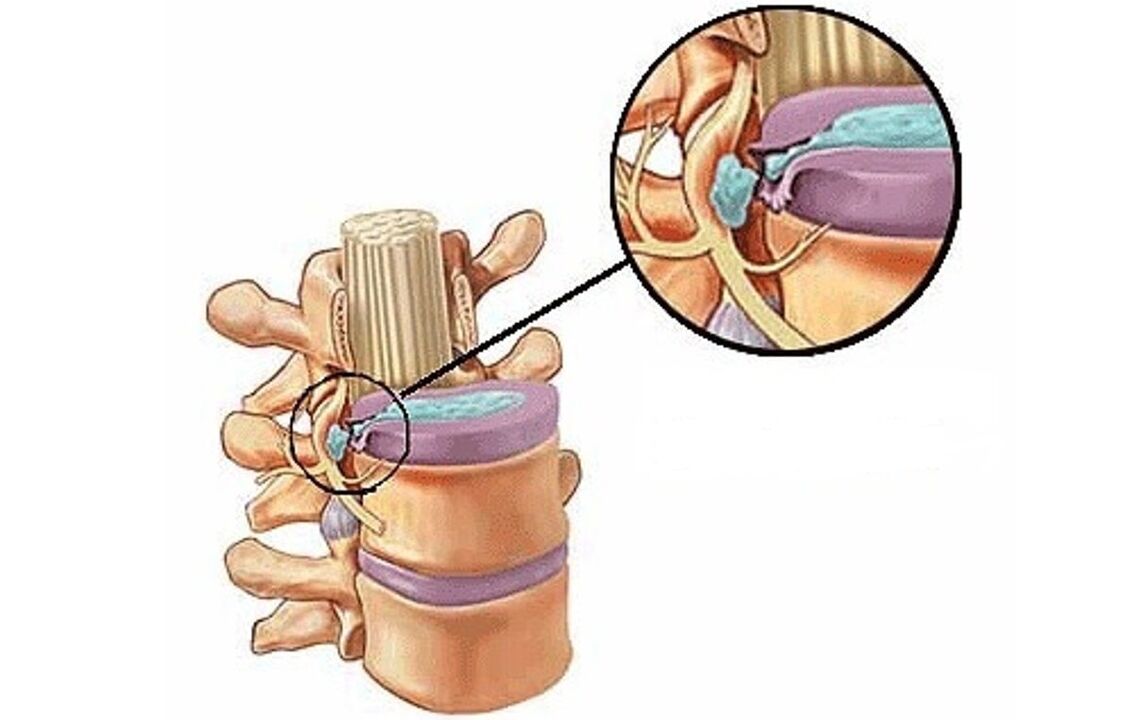 Torasik osteokondrozlu intervertebral fıtık