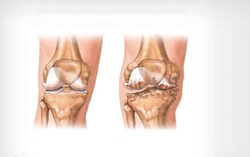 Diz ekleminin osteoartriti
