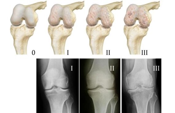 Diz osteoartritini teşhis etme yöntemleri