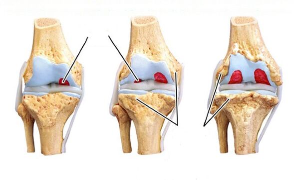 Diz osteoartritinin aşamaları